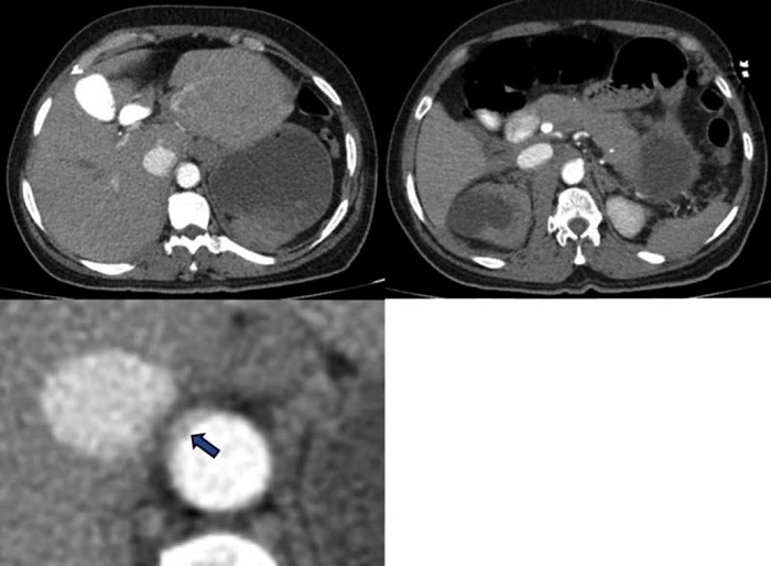 Angiotomograf&iacute;a en cortes axiales. Se observa trombo mural (flecha azul) en el aspecto anterior y lateral, extendi&eacute;ndose desde la aorta diafragm&aacute;tica (A) hasta el origen del tronco cel&iacute;aco (B).