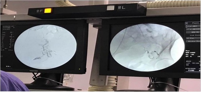 Embolización de vasos anómalos: se evidenció múltiples vasos malformados de placenta de alto flujo y lagos venosos. Se realiza angiografía con disminución del 80 % del flujo respetando los vasos nativos. Sangrado mínimo.