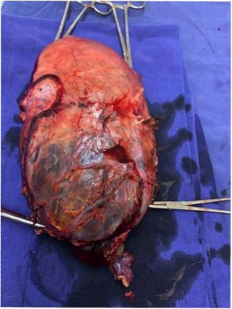 Placenta percreta: infiltración de pared anterior del segmento inferior, serosa de vejiga, ligamento redondo bilateral y pedículo de arterias uterinas bilaterales. Vejiga ascendida y adherida segmento uterino.