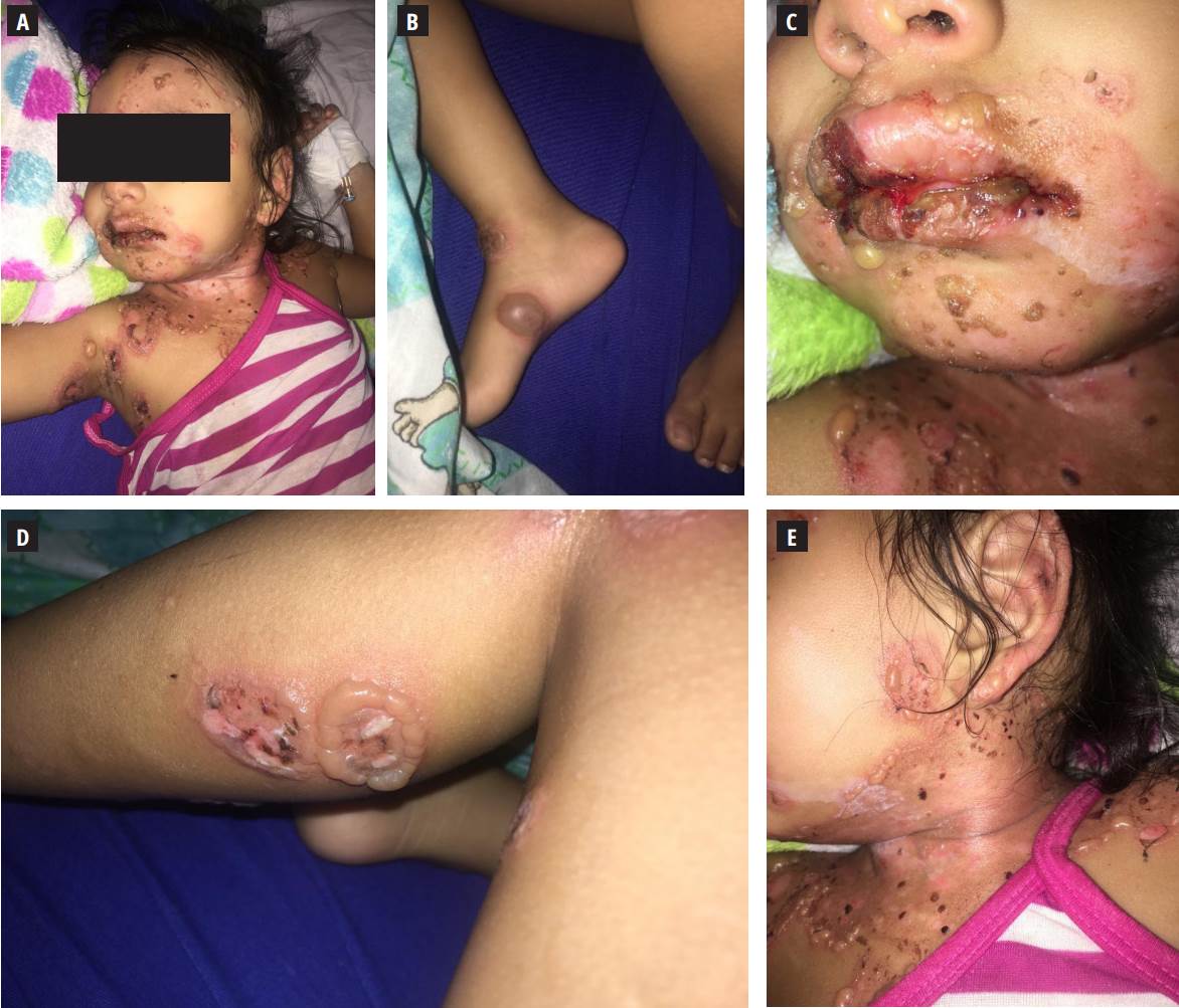 Lesiones ampollosas presentes en la paciente. A y C: lesiones ampollosas en labios y mucosa oral. B y D: lesiones ampollosas presentes en extremidades inferiores. C y E: lesiones ampollosas en cuello y extremidades superiores.