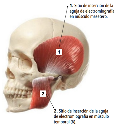 Sitios de inserci&oacute;n de electrodo de aguja en los m&uacute;sculos masetero y temporal