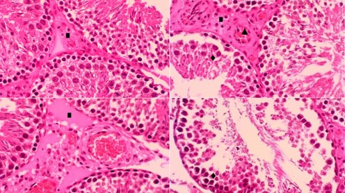 Micrografia del testculo de ratas tratadas con ibuprofeno. Incremento de tejido conjuntivo intersticial (∎), congestin vascular intersticial (▲), dao severo en las clulas germinales de la pared del tubo seminfero (♦) (H/E) 40x.