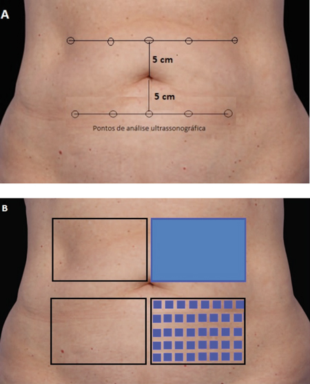Demonstração da marcação das subáreas para realização do exame e tratamento