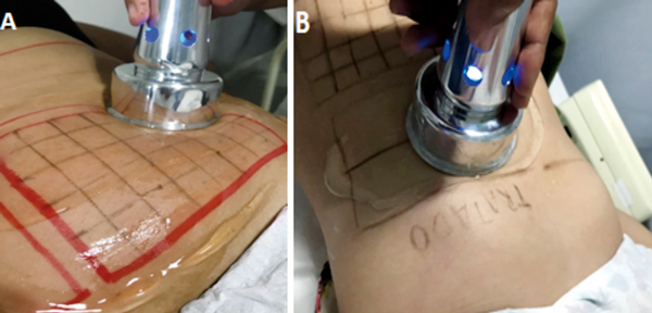 Tratamento da região abdominal