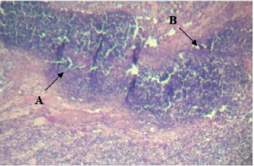 CORTE HISTOLÓGICO DE GANGLIO PAROTÍDEO CON SIGNOS DE LINFADENITIS CASEOSA, ÁREAS DE NECROSIS CASEOSA (A) Y EOSINOFILIA (B). TINCIÓN HE (400X).