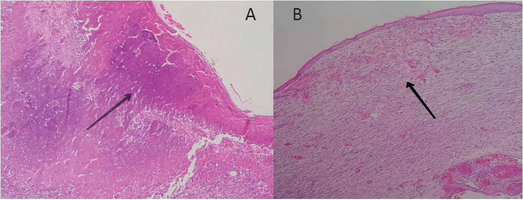 MICROFOTOGRAF&Iacute;AS DE LAS CARACTER&Iacute;STICAS HISTOL&Oacute;GICAS DE LOS PROCESOS DE CICATRIZACI&Oacute;N A LOS SIETE D&Iacute;AS DESPU&Eacute;S DE LA LESI&Oacute;N: A) HERIDA SIN TRATAMIENTO, CON NECROSIS (INDICADO POR LA FLECHA); B) HERIDA TRATADA CON EL L&Aacute;TEX DE SD, CON TEJIDO DE GRANULACI&Oacute;N (INDICADO POR LA FLECHA). TAMA&Ntilde;O DE LA MUESTRA: 4X.