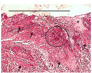 TINCI&Oacute;N DE H-E, MOSTRANDO LA
PRESENCIA DE SEVERA DERMATITIS PIOGRANULOMATOSA, MULTIFOCAL Y DIFUSA. OBSERVE
LA ULCERACI&Oacute;N DEL EPITELIO (BARRA), AS&Iacute; COMO M&Uacute;LTIPLES FEN&Oacute;MENOS DE SPLENDORE-HOEPPLI
(FLECHAS NEGRAS), CON FOCOS DE MARCADA NECROSIS CON EOSIN&Oacute;FILOS Y
NEUTR&Oacute;FILOS (C&Iacute;RCULOS) Y &Aacute;REAS DE EDEMA (ASTERISCO). 20X.