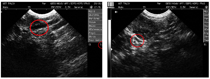 ECOGRAF&Iacute;A ABDOMINAL. COMPARACI&Oacute;N
ENTRE UR&Eacute;TER IZQUIERDO DE 5,14 MM DE DI&Aacute;METRO (A) Y DERECHO DE 2,74 MM DE
DI&Aacute;METRO (B).