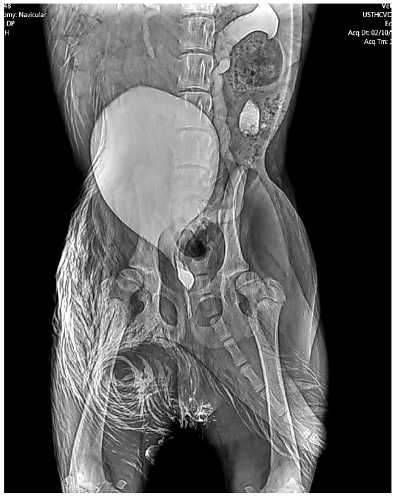RADIOGRAF&Iacute;A CONTRASTADA MUESTRA UR&Eacute;TER ECT&Oacute;PICO UNILATERAL.