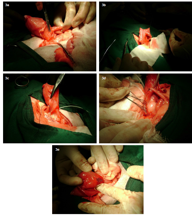 T&Eacute;CNICA QUIR&Uacute;RGICA COMBINADA EN
EL ABORDAJE DE UR&Eacute;TER ECT&Oacute;PICO UNILATERAL E INTRAMURAL.