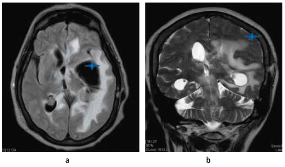 a. RMN cerebral T1 se evidencia colocaci�n de sistema de derivaci�n ventriculoperitoneal SDVP en ventr�culo lateral Izq b. Corte coronal donde se evidencia cabo proximal de SDVP