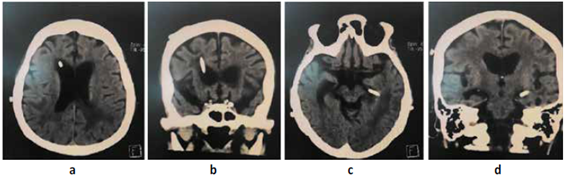 a,b. TEM cerebral presencia de SDVP en ventr�culo lateral frontal as� mismo disminuci�n de edema y ausencia de tumoraci�n c,d. TEM cerebral presencia de SDVP en ventr�culo lateral izquierdo