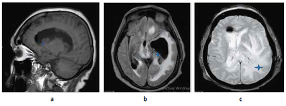 a,b. RMN Cerebral corte sagital y axial T1 donde se evidencia im�genes nodulares a isointensas que cubren el cuerpo calloso y se encuentran en ventr�culos laterales en corte axial se evidencia edema transependimario y dilataci�n de II y III ventr�culo ocasionado por tumoraci�n ipsilateral isointensa c Flair se evidencia edema perilesional a nivel de ventr�culo lateral izquierdo que ocasiona efecto de masa y desv�a l�nea media.