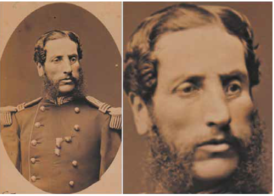 Andr�s A. C�ceres, 1875 aproximadamente. Se observa cicatriz hipertr�fica del canto medial con severa tracci�n y ectropi�n cicatrizal. El tratamiento de reconstrucci�n en Francia se hab�a realizado m�s de 10 a�os antes.