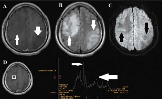 RMN cerebral contrastada preoperatoria. A. En imagen T1 contrastada se observa dos lesiones hipointensas difusas y mal definidas no captadoras de contraste en regi�n frontal derecha (flecha) y parietooccipital izquierda (flecha gruesa), ambas con edema vasog�nico perilesional. B. Dichas im�genes son suprimidas en la secuencia flair (flecha). C. En el estudio de difusi�n se evidencia restricci�n leve en algunos fragmentos (flecha). D. La curva de espectroscopia muestra elevaci�n de la colina (flecha) y descenso del pico de n-acetilaspartato (flecha gruesa) en el boxel que est� en la lesi�n frontal derecha.