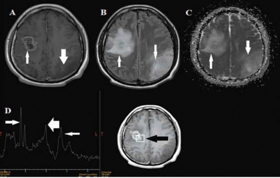 RMN cerebral contrastada control a los 8 meses posoperatorios. A. En imagen T1 contrastada se observa lesi�n parietooccipital izquierda con ligera disminuci�n del volumen (flecha gruesa) y lesi�n frontal derecha con captaci�n de contraste en la periferia e hipointensidad en el centro como secuela posquir�rgica (flecha). B. Supresi�n leve en secuencia FLAIR en ambas lesiones (flecha). C. Restricci�n en ambas lesiones en la secuencia de difusi�n (flecha). D. La curva de espectroscopia muestra elevaci�n de la colina (flecha), descenso del pico de n-acetilaspartato (flecha gruesa) y un pico peque�o de l�pido/lactato en el boxel que est� en la lesi�n frontal derecha (flecha oscura).