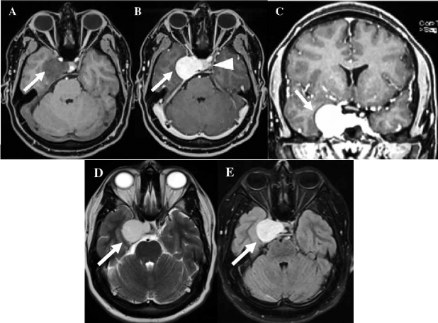 RMN cerebral. A. Corte axial en secuencia T1 donde se evidencia proceso expansivo hipointenso en el seno cavernoso derecho (flecha). B. Corte axial en secuencia T1 contrastada que evidencia que el proceso expansivo capta �vidamente contraste (flecha) e invade la silla turca desplazando la hip�fisis hacia la izquierda (cabeza de flecha). C. Corte coronal en secuencia T1 contrastada que evidencia el proceso expansivo hipercaptador de contraste (flecha). D. Corte axial en secuencia T2 que evidencia que el proceso expansivo del seno cavernoso es altamente hiperintenso (flecha). E. Corte axial en secuencia FLAIR que evidencia el proceso expansivo hiperintenso (flecha).