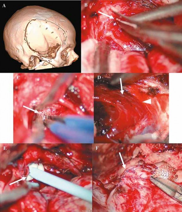 Reconstrucci�n tomogr�fica �sea 3D que evidencia la craneotom�a fronto temporal derecha, adem�s se puede evidenciar que se resec� el zigoma (flecha) para proceder al abordaje del tumor. B, C, D, E, F. Im�genes intraoperatorias. B. Se incide la c�psula del tumor del seno cavernoso con microtijera (flecha) y se logra observar el IV nervio craneal derecho (asterisco). C. Se evidencia la cavidad intatumoral luego del debulking (fecha), lo cual est� siendo coagulado con bipolar. D. Se logra ver el tumor hacia anterior (flecha) y el l�mite posterior de la tumoraci�n (cabeza de flecha). E. Se coloca Surgiflo � (flecha) en el lecho quir�rgico para cohibir el sangrado profuso, lo cual se logra de manera adecuada. F. Se cierra de manera herm�tica las paredes del seno cavernoso derecho (flecha).