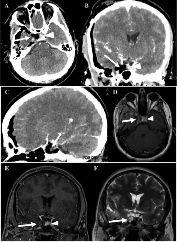 Tomograf�a cerebral contrastada posoperatoria inmediata. A. Corte axial donde se evidencia resecci�n total de la tumoraci�n (flecha) y la hip�fisis desplazada hacia la izquierda (cabeza de flecha). B. Corte coronal donde no se logra evidenciar la tumoraci�n (flecha) con la hip�fisis desplazada hacia la izquierda (cabeza de flecha). C. Corte sagital donde no se evidencia la tumoraci�n (flecha). D, E y F. Resonancia cerebral posoperatoria 2do mes. D. Corte axial, secuencia T1 con contraste, donde se evidencia secuela posquir�rgica, pero con resecci�n total de la lesi�n (flecha), con hip�fisis desplazada hacia la izquierda (cabeza de flecha). E. Corte coronal, secuencia T1 con contraste, donde se logra evidenciar lecho quir�rgico sin presencia de tumor (flecha), con hip�fisis desplazada hacia la izquierda (cabeza de flecha). F. Corte coronal, secuencia T2, donde se evidencia lecho quir�rgico sin presencia de tumor (flecha).