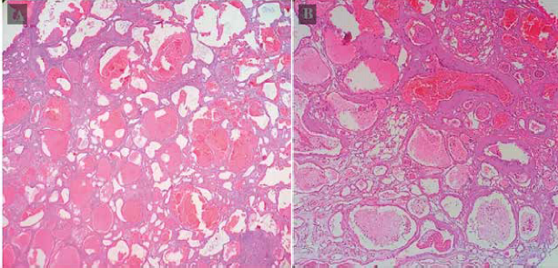 Gran proliferaci�n de vasos sangu�neos a modo de grandes lagos vasculares (HE, 10x). B. Vasos sangu�neos de diferentes di�metros, a predominio de grandes lagos vasculares, algunos de paredes sumamente delgadas constituidas s�lo por endotelio, y otros de paredes fibrosadas carentes de muscular (HE, 40x).