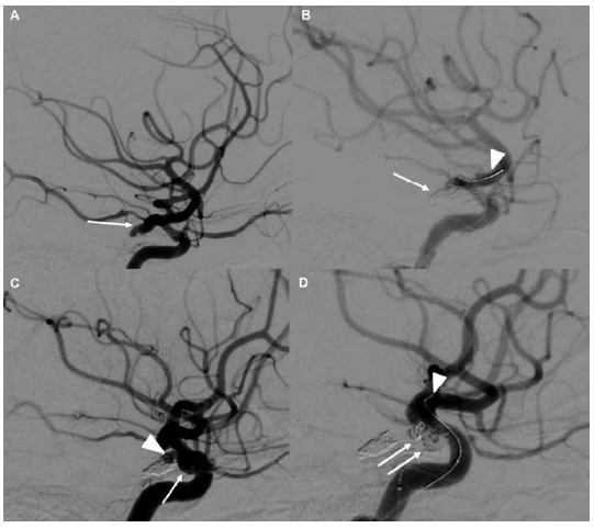 Caso Ilustrativo. Mujer de 38 a�os ingresa con cefalea s�bita y v�mitos la angiotomograf�a muestra una hemorragia subaracnoidea y 3 aneurismas comunicante posterior izquierdo roto y 2 aneurismas no rotos en el segmento oft�lmico de la arteria car�tida derecho Se us� la t�cnica de remodeling en los 3 aneurismas (A) Angiograf�a de arteria car�tida interna ACI izquierda en vista lateral muestra un aneurisma de arteria comunicante posterior roto flecha (B) Vista lateral de la ACI izquierda muestra una adecuada obliteraci�n con coils del aneurisma flecha adem�s se evidencia la parte distal del microcat�ter bal�n y la microgu�a cabeza de flecha (C) ACI derecha en vista lateral que muestra 2 aneurismas no rotos en el segmento oft�lmico cabeza de flecha y flecha (D) ACI derecha en vista lateral que muestra la adecuada obliteraci�n de ambos aneurismas flechas adem�s se logra evidenciar la parte distal del microcat�ter bal�n y la microgu�a cabeza de flecha