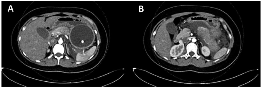 TEM abdomen A Bal�n intrag�strico comprimiendo la cola del p�ncreas B Cambios inflamatorios y escaso l�quido peripancre�tico asociado a aumento de volumen a nivel de la cola del p�ncreas