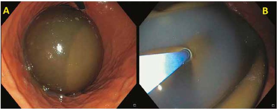 A y B Retiro del bal�n intrag�strico mediante endoscop�a digestiva alta