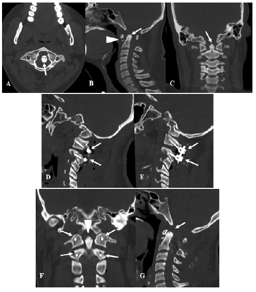 Var�n de 25 a�os que sufre ca�da libre desde un segundo piso ingresando con cuadriparesia moderada 35 diagnosticando invaginaci�n basilar por lo cual se le realiza una fijaci�n interarticular C1C2 con mejor�a del d�ficit motor en el posoperatorio inmediato 45 A B y C TEM de columna cervical preoperatoria A Corte axial donde se evidencia que la ap�fisis odontoides se encuentra desplazada hacia atr�s y la izquierda flecha B Corte sagital donde se evidencia desplazamiento de la ap�fisis odontoides hacia superior y posterior flecha adem�s de fractura del borde inferior del arco anterior de C1 cabeza de flecha C Corte coronal donde se evidencia ap�fisis odontoides desplazada hacia la izquierda flecha D E F y G TEM de columna cervical posoperatoria de una artrodesis interarticular D Corte sagital donde se logran evidenciar los tornillos de C1 y C2 flechas en el lado derecho E Corte sagital donde se evidencian los tornillos de C1 y C2 flechas en el lado izquierdo F Corte coronal donde se evidencia odontoides ya en ubicaci�n central cabeza de flecha adem�s de los 4 tornillos de la fijaci�n interarticular flechas con correcta situaci�n del sistema G Corte sagital donde se evidencia adecuada reducci�n de la ap�fisis odontoides desplazada flecha