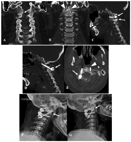 Mujer de 49 a�os con antecedente quir�rgico de descompresi�n occipitocervical por malformaci�n de Chiari quien present� cervicalgia severa EVA 1010 debido a inestabilidad atlantoaxoidea por lo que se procede a una artrodesis C1C2 con posterior mejor�a cl�nica significativa A y B Tomograf�a espiral multicorte TEM de columna cervical preoperatoria en corte coronal donde se logra evidenciar la presencia de aire en articulaci�n C1C2 derecha flecha adem�s de bordes escler�ticos en la articulaci�n de la odontoides con C1 cabeza de flecha los cuales son signos radiol�gicos de inestabilidad segmentaria C D y E TEM de columna cervical posoperatoria C Corte sagital donde se logra evidenciar una artrodesis interarticular C1C2 flechas del lado derecho luego de un primer intento de fijaci�n transarticular frustro D Corte sagital donde se evidencia el tornillo transarticular C1C2 del lado izquierdo flecha E Corte axial donde se logra evidenciar C1 con el tornillo en el lado derecho flecha y el extremo distal del tornillo transarticular C1C2 del lado izquierdo cabeza de flecha F y G Radiograf�a funcional de la columna cervical en flexi�n F y en extensi�n G donde no se evidencia movilidad interarticular C1C2 flecha lo cual indica que se ha logrado la estabilidad segmentaria