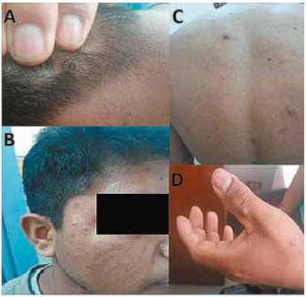 Lesiones d�rmicas umbilicadas en A) Cuero cabelludo B) Regi�n temporal C) Regi�n posterior del t�rax D) Dorso de la mano izquierda.