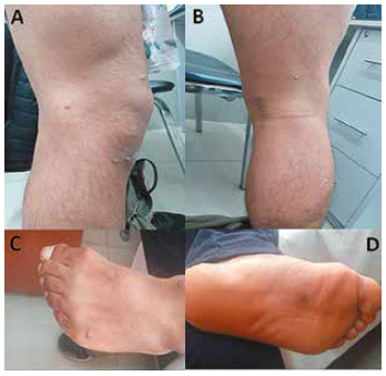 Lesiones d�rmicas umbilicadas en A Dorso del pene B Regi�n ventral del pene