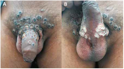 Lesiones d�rmicas umbilicadas en A) Dorso del pene B) Regi�n ventral del pene.