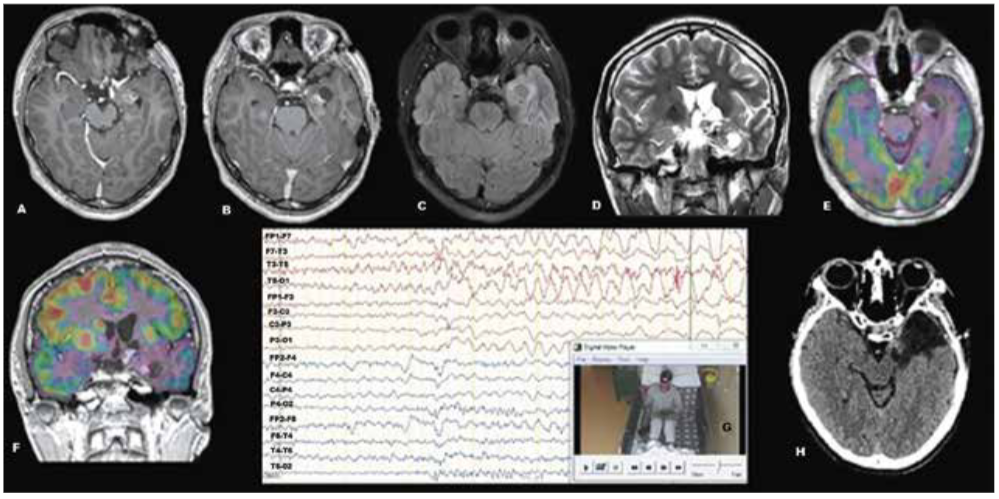 Estudio prequirrgico para ciruga de epilepsia. RM de encfalo: tumor qustico temporal anteromesial izquierdo y malacia orbitofrontal izquierda (A,B,C,D). PET scan interictal: extenso hipometabolismo izquierdo a predominio mesial (E,F). VideoEEG ictal: zona epileptgena temporal anterior – media izquierda (G). Tomografa cerebral postoperatoria: lobectoma temporal izquierda.