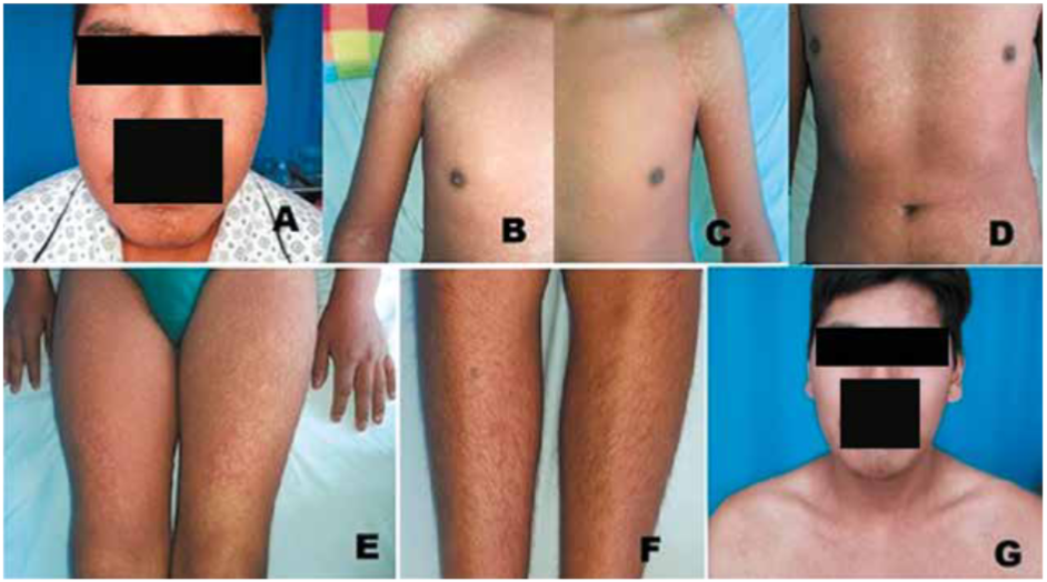 Erupcin cutnea morbiliforme como parte de DRESS. Fase inicial de DRESS (A – F). Fase de recuperacin (G).